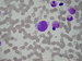 Centrally a rhabdomyoblast with a large nucleus and abundant vacuolised cytoplasma.
The peripheral cytoplasm is basophilic,
in the perinuclear zone acidophilic. Nuclear
chromatin is granular.
  / V centru rhabdomyoblast s velkm jdrem a bohatou, vakuolizovanou cytoplasmou.
Cytoplasma je na periferii basofiln, perinuklern acidofiln. Jadern chromatin je hrub granulrn.
