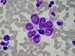 Rosette - shaped rhabdomyoblasts, Upward probably one multinuclear cell, downward on the left binucleated cell. All cells with abundant vacuolised cytoplasm. The peripheral cytoplasm is basophilic, the perinuclear zone in some cells acidophilic. / rozetovit uspodan rhabdomyoblasty, buky v horn sti  spe splvaj, snad jde o jednu vcejadernou b., vlevo dole buka dvoujadern, cytoplasma je ve vech bukch bohat vakuolizovna, na periferii basofiln, perinuklern u nkterch bb. acidofiln