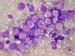 Nidus of rhabdomyosarcoma cells, containing numerous vacuole-like empty spaces, sometimes creating lacoon-like spaces. Marginal erytrophagocytosis. / loisko  rhabdomyosarkomovch bunk, obsahujcch etn vakuoly,  z nich nkter splvaj a vytvej tzv."jezrka." Naznaena fagocytoza erytrocyt.