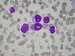 Upwards round rhabdomyoblast, below a spindle-shaped rhabdomyoblast, containing phagocyted red blood cells. Vacuoles are sporadic in both cells. / nahoe kulat, pod nm vetenovit rhabdomyoblast, kter obsahuje zfagocytovan erytrocyty. Vakuoly jsou zde ojedinl.