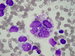 a large, multinuclear rhabdomyosarcoma cell,
containing vacuoles and numerous phagocyted red blood cells, left three rhabdomyosarcoma cells, partially vacuolised, right a small, round cell with sporadic vacuoles . In the large cells the nuclear  chromatin  is  more rare, in the small cells more dense. / V horn sti velk vcejadern rhabdomyosarkomov b. obsahujc vakuoly a etn fagocytovan ery. V levo ti rhabdomyosarkomov bb., sten vakuolizovan , v pravo mal kulat buka sporadickmi  vakuolami. U vtch bb. je jadern chromatin id, u malch je hutnj.
