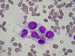 a group of spindle shaped, or round rhabdomyoblasts with numerous vacuoles,
some of them binucleated                         / skupina rhabdomyoblast vetenovitho., nebo kulatho tvaru s etnmi vakuolami, nkter dvoujadern.