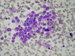 The neroblastoma rosette in the low power magnification. / Neuroblastomov rozeta pehlednm zvtenm.