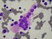 A large bundle of neurofibrilles, suronding a neuroblastoma cell rosette. / Velk svazek neurofibril obklopujcch rozetu neuroblastomovch bunk.
