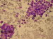 Two neuroblastoma cells rosettes in low power magnification.
Note the neurofibriles among the cells. / Dv neuroblastomov rozety v pehlednm zvten.
Neurofibrily mezi ndorovmi bukami.
