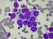 A group of Ewings sarcoma cells.
Centrally a cell with a  large nucleus and visible nucleoli, others cells with  inconspicious nucleoli .
All cells with grey-blue, irregular stained cytoplasm, indistinct intercellular borders. / Loisko bunk Ewingova sarkomu. V centru buka
s vtm  jdrem s patrnmi jadrky, v ostatnch bukch jadrka nejsou npadn. 
Buky s edomodrou nepravideln vybarvenou cytoplasmou, nejsou zeteln hranice mezi bukami.
