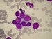 A group of Ewings sarcoma cells.
Some cells with large and  light-coloured nuclei, nucleoli are visible, other cells with smallish, darkly coloured nuclei, without visible nucleoli. 
Grey-blue cytoplasm with fine vacuoles, indistinct intercellular borders. / Loisko bunk Ewingova sarkomu. Vidme jednak buky s vtmi, svtleji vybarvenmi jdry, kter maj patrn jadrka, jednak buky s menmi, tmavji vybarvenmi jdry, bez patrnch jadrek.
Cytoplasma edomodr s drobnmi vakuolkami.  Hranice mezi bukami nejsou patrn.