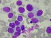 A group of Ewings sarcoma cells.
Significant cell anisocytosis. Largecells are containig trabecular and granular chromatine and visible bluish nucleoli, smaler cells have dark-colored chromatine without visible nucleoli.  Light grey-blue and irregularly colored cytoplasm, indistinct intercellular borders.
Rarely see cytoplasmic vacuoles.
At the bottom of the picture, large platelet agregates seen / Loisko bunk Ewingova sarkomu. Vrazn anisocytosa bunk. Vt buky s idm trmitm chromatinem jadernm s patrnmi modravmi jadrky, men buky s tmavji se barvcm chromatinem bez patrnch jadrek.
Svtl modroed cytoplasma nepravideln vybarven, hranice mezi bukami splvaj.
Msty v cytoplasm vakuoly.
Ve spodn sti obrzku velk shluky trombocyt.
