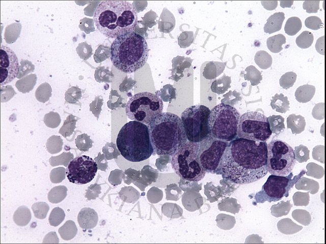 CML - peripheral blood
