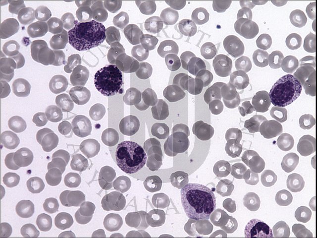 CML - peripheral blood