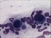 The increase count of the smaller megakaryocytes with hypolobated nuclei  is the typical change in megakaryocytic  maturation in bone marrow.  / Zven potu malch megakaryocyt s hypolobulizovanmi jdry je typickou zmnou ve vyzrvn megakryocyt v kostn deni. 