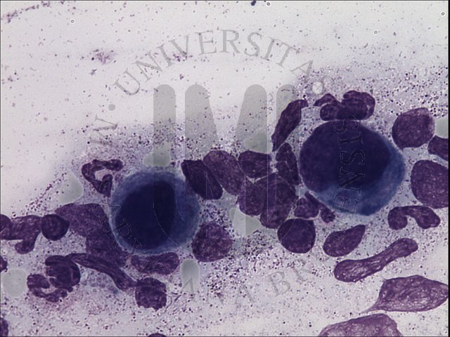 CML - bone marrow