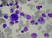 In the left part on the picture there  is immature megakaryocyte with single nucleus and withaut mature granulomer.
In the right part of the picture we can see the beginning of the apoptosis of the neutrophil. 
In the myelocytes and metamyelocytes you can see hypergranularity. / V lev sti obrzku nezral megakaryocyt s nefragmentovanm jdrem a nevytvoenm granulomerem.
V prav sti obrzku ponajc apoptza neutrofilu.
V bukch myeloady hypergranulace.