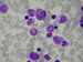 Large metamyelocyte and three blasts with visible nucleoli. / Na obrzku je obrovsk metamyelocyt a ti blasty s viditelnmi jadrky.