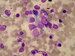 For comparison tumor-imprint/touch preparation of neuroblastoma:
Group of neuroblastoma cells in the centre showing a ganglioid diferentation ( large light nucleus with nucleoli). / Pro srovnn otisk tumoru (neouroblastomu).
V centru skupina bunk neuroblastomu, s ganglioidn diferernciac (velk svtl jdro  s jadrky).