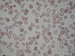 hypochromic erythrocytes, several target cells
and rare ovalocytes  / hypochromn erytrocyty, nkolik terovitch erytrocyt a ojedinle i ovalocyty