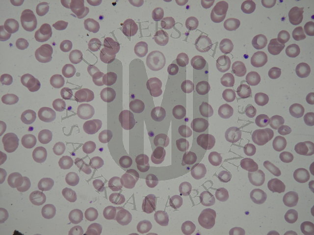 target cells, ovalocytes