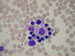 Macrophage (in center) surrounded by cluster of mature erythroblasts. The macrophage phagocytoses defective erythroblasts and extruded erythroblast nuclei. Macrophage also serves as a "iron store" for erythroblasts. / Makrofg (siderofg) uprosted slou jako zsobrna Fe. Je obklopen koncentrickm prstencem vyzrvajcch polychromatofilnch normoblast. Makrofg fagocytuje defektn erytroblasty a jdra, kter jsou v prbhu zrn z erytroblast vylouena. 

