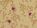 Two monocytes with fine nuclear chromatin and prominent with irregular nucleus and more mature grayish-blue cytoplasm with a few small vacuoles (cell at the top).  / Dva monocyty s jemnm jadernm chromatinem a promonocyt s nepravidelnm tvarem jdra a vce zralou edo-modrou cytoplazmou s nkolika malmi vakuolami (buka nahoe). 