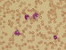 Monocytes in peripheral blood reach to 47% (absolute number 12,7G/l) at the time of diagnosis. One segmented neutrophil at 4 o'clock.  / Monocyty v perifern krvi dosahuj v ase diagnzy 47% (absolutn poet 12,7G/l)- Jeden neutrofiln segment na 4. hodin. 