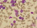 Several blasts with heterogeneous morphology, one monocyte and two eosinophils. This one at the left is really immature (promyelocyte), has a few large granules purple-violet in colour reminding basophilic granulation mixing with eosinophlic granules.  Naked nuclei and damaged cells. / Nkolik blast rznorod morfologie, jeden monocyt a dva eozinofily. Ten vlevo je skuten nezral (promyelocyt), m nkolik velkch granul purpurov-fialov barvy pipomnajc basofiln granulaci smchanch s granulemi eozinofilnmi. Hol jdra a pokozen buky. 