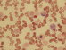 Staining of naftol ASC chloracetate esterase is positive in neutrophil lineage, negative in monocytic cells. In this case AML inv(16) is faintly positive reaction in abnormal eosinophils (at 5 and at 12 o'clock) - usually are eosinophils negative.  / Barven na chloracett esterzu je pozitivn v neutrofiln ad, negativn v monocytrnch bukch. V tomto ppad AML inv(16) je slab pozitivn reakce v abnormlnch eozinofilech (na 5. a 12. hodin)- obvykle jsou eozinofily negativn. 