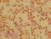 Staining of alpha naphthyl acetate esterase is strong positive in monocytic cells and rather weakly positive in granulocytic cells.  / Barven na nespecifickou esterzu je siln pozitivn v monocytrnch bukch a spe slab pozitivitn v granulocytrnch bukch. 