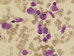 Blasts and promonocytes, eosinophils with atypical "basophil like" granulation. One promyelocyte at 5 o' clock. Eosinophil component reaches almost 14% of nucleated bone marrow cells.  / Blasty a promonocyty, eozinofily s atypickou granulac napodobujc "basofiln". Jeden promyelocyt na 5. hodin. Eozinofiln komponenta dosahuje tm 14% z jadernch bunk kostn den. 