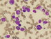 Hyper-cellular bone marrow with mixture of tumour cells of granulocytic and monocytic lineages. Two characteristic eosinophil myelocytes, that in at right has vacuolized cytoplasm. Eosinophil the mostly at right is promyelocyt with numerous purple pro-granules.    / Hypercelulrn kostn de se sms ndorovch bunk granulocytrn a monocytrn linie. Dva charakteristick eozinofiln myelocyty, ten vpravo m vakuolizovanou cytoplazmu. Eozinofil nejvce vpravo je promyelocyt s poetnmi purpurovmi progranuly. 