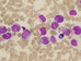 Six blasts with weakly to strong basophilic rather voluminous cytoplasm. Rest of the cells are promonocytes, destroyed cells, naked nuclei  and one plasma cell (at 3 o'clock).  / est blast se slab a siln basofiln spe objemnou cytoplazmou. Zbytek bunk jsou promonocyty, rozbit buky, hol jdra a jeden plazmocyt (na 3. hodin). 