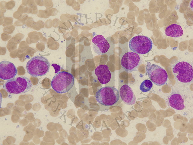 AML M5a peripheral blood