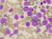 Hyper-cellular bone marrow which contains 86,2%   monoblasts (>80% of all nucleated cell of bone marrow are of monocytic lineage; > 80% of monocytic lineage are monoblasts). Hemophagocytosis - erythrophagocytosis can be observed (monoblast at right from the middle; in this patient cytogenetic analysis to prove association with  t(8;16) has not done ).  / Hypercelulrn kostn de, kter obsahuje 86,2% monoblast (>80% z jedernch bunk dene jsou monocytrn linie, >80% monocytn linie jsou monoblasty). Me bt pozorovna hemofagocytza - erytrofagocytza (monoblast napravo od stedu; u tto pacientky cytogenetick analza k potvrzen asociace s t(8;16) nebyla provedena ). 