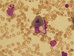 In the middle of the picture is dysplastic erythroblast  with mature abundant ortochomatophilic cytoplasm and irregular shape of the nucleus. Two blast, that at 11 o'clock is myeloblast with numerous azurophilic granules.
 / Uprosted obrzku je dysplastick erytroblast se zralou bohatou ortochromatofiln cytoplazmou a nepravidelnm tvarem jdra. Dva blasty, ten na 11. hodin je myeloblast s poetnmi azurofilnmi granuly. 