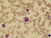 Late erythroblasts - that one in the middle with atypical mitosis and Howell-Jolly body, another one (at 8 o'clock) with completely fragmented nucleus.    / Pozdn erytroblasty - ten uprosted s atypickou mitzou a Howell-Jollyho tlskem, dal (na 8. hodin) s kompletn fragmentovanm jdrem. 