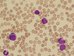 Myeloblasts - Auer rods are present in several blasts  / Myeloblasty - v nkolika blastech ptomny Auerovy tye