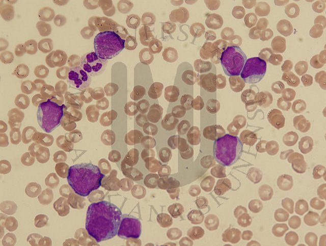 AML M2- peripheral blood 3