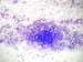 Bone marrow aspirate. Cluster of tumor cells among normal haematopoietic cells. / Kostn de z lopaty kosti kyeln vlevo. Mezi bukymi fyzilogick krvetvorby skupina ndorovch bunk, kter tvo rozetu. 