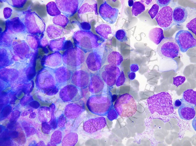 DSRCT-Tumor cells in bone marrow