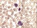 One segmented neutrophil and two atypical monocytes - they have more basophilic cytoplasm and lower one has obvious and large nulceoli.    / Jeden neutrofiln segment a dva atypick monocyty - maj vce basofiln cytoplazma a spodn m jasn a velk jadrka. 