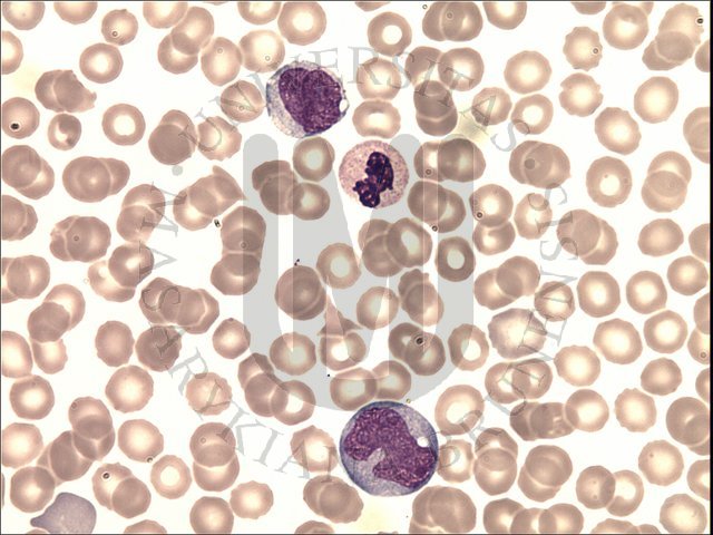 AML M5b peripheral blood