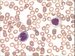 Monoblasts at peripheral blood smear. Their cytoplasm is abundant, vacuolized and intensely (at right) to moderate (at left) basophilic.  Nuclei are rather round with delicate chromatin and prominent nucleoli.   / Monoblasty v perifern krvi. Jejich cytoplazma je bohat, vakuolizovan a intenzivn (vpravo) a stedn (vlevo) basofiln. Jdra jsou spe kulat s jemnm chromatinem a prominujcmi jadrky. 