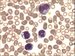 More or less mature cells of monocytic lineage form dominant population in peripheral blood.  / Vce i mn zral buky monocytrn ady tvo dominujc populaci v perifern krvi. 