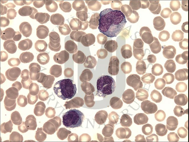 AML M5b peripheral blood