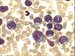 Promonocytes, monocytes and one monoblast (at 5 o'clock). The presence of neutrophil cells can be rarely find (segmented neutrophil at 11 o'clock).  Monocytic lineage represents > 80% nucleated bone marrow cells.    / Promonocyty, monocyty a jeden monoblast (na 5. hodin). Vzcn me bt zastiena ptomnost neutrofilnch bunk (neutrofiln segment na 11. hodin). Monocytrn ada pedstavuje > 80 % jadernch bunk den. 
