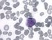 "Faggot cell" in blood smear (bundles of Auer rods). / Ptomnost "faggot cell" v ntru perifern krve (snopce Auerovch ty).