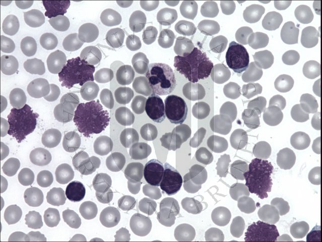 Lymphocytic Leukaemia