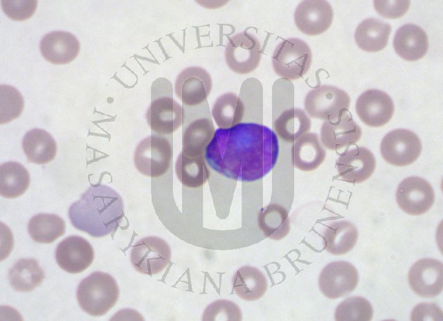 AML- peripheral blood
