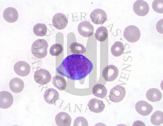 AML- peripheral blood