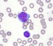 The II-nd type of myeloblast in AML; there are few fine azurophilic granules in cytoplasm at the right side of the nucleus. It contains three apparent nucleoli. Underneath of this cell is mature lymphocyte.  / Myeloblast II. typu u AML, vpravo od jdra je v cytoplazm nkolik azurofilnch granul. Jdro obsahuje t zeteln jadrka.  Pod touto bukou je zral lymfocyt. 