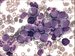 Marked leucocytosis with granulocytosis. Myelocytes and segmented granulocytes are predominant elements of peripheral blood, marked basophilia. At the picture blasts and promyelocytes are present, six basophiles.
 / Vrazn leukocytza s granulocytzou. Myelocyty a neutrofiln segmenty jsou dominujcmi elementy v ntrech perifern krve, vrazn bazoflie. Na obrzku ptomny i blasty a promyelocyty, est bazofil. 


